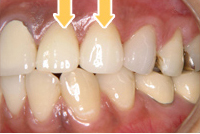 症例写真：オールセラミックス