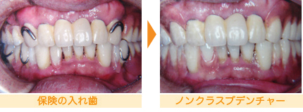 「保険の入れ歯」と 「ノンクラスプデンチャ－」の比較1