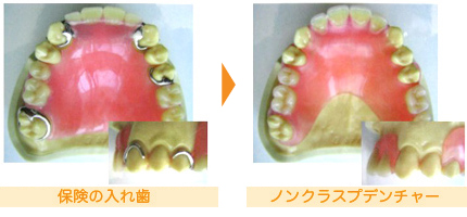 「保険の入れ歯」と 「ノンクラスプデンチャ－」の比較2