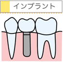 インプラント