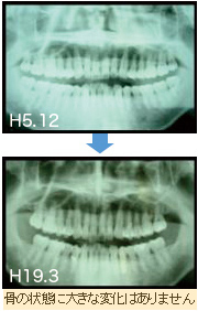 症例：骨の状態に大きな変化はありません
