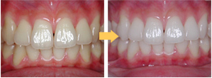 ホワイトニング症例1